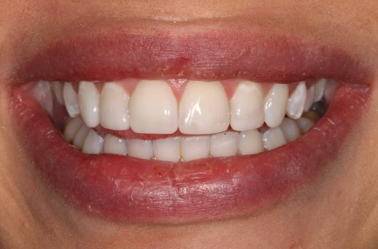 Composite Bonding