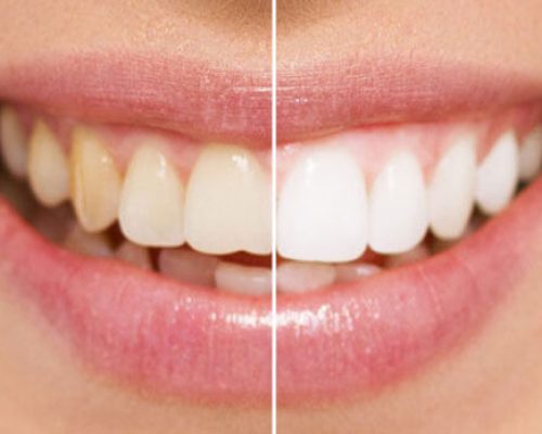 Lamine Veneers