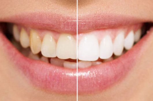 Lamine Veneers