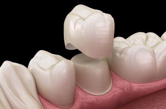 Zirconium Crown